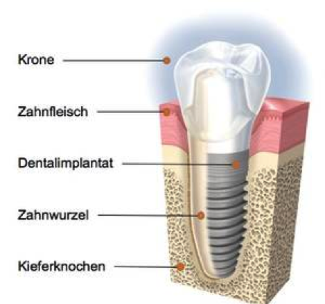 Erklärung eines Zahnimplantats